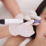 microneedling